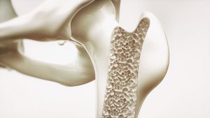 Leczenie osteoporozy – jest na to sposób